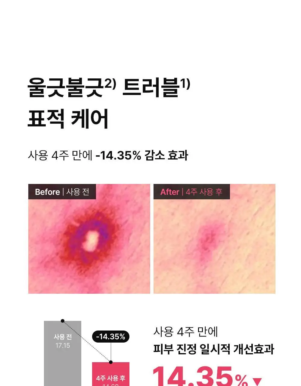 [트러블표적케어] 동아제약 아크네 프로 크림제 30ml 상세페이지 11